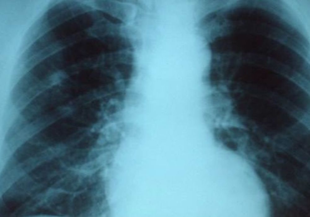 Pneumonia Hospitalisation Linked To Increased Risk of CVD