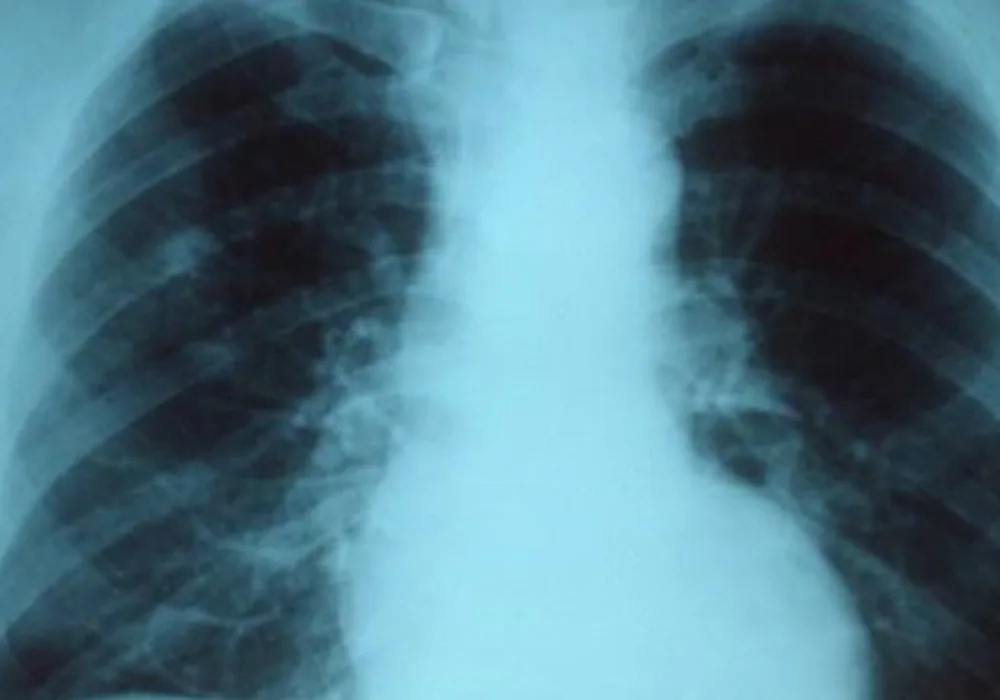 Pneumonia Hospitalisation Linked To Increased Risk of CVD