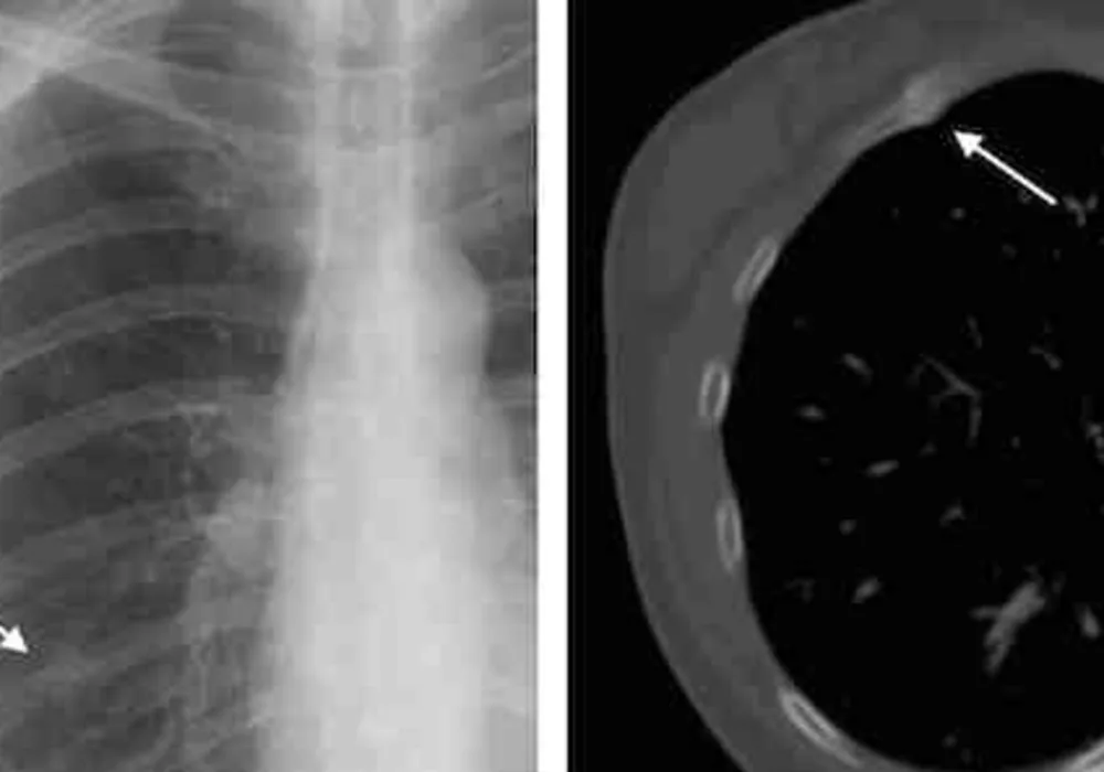 Radiologist Recommendations for Chest CT Clinically Relevant 