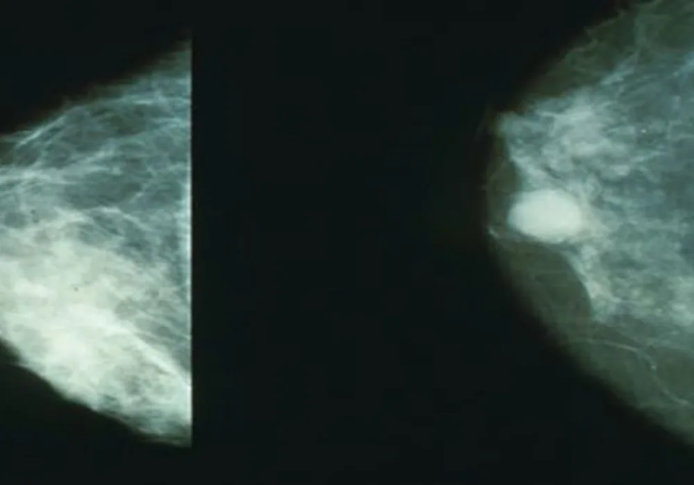 Breast Density Better Predicts Breast Cancer Risk