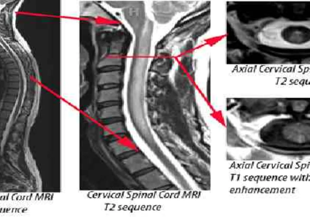 Peptides: New Promise for Spinal Cord Injury?