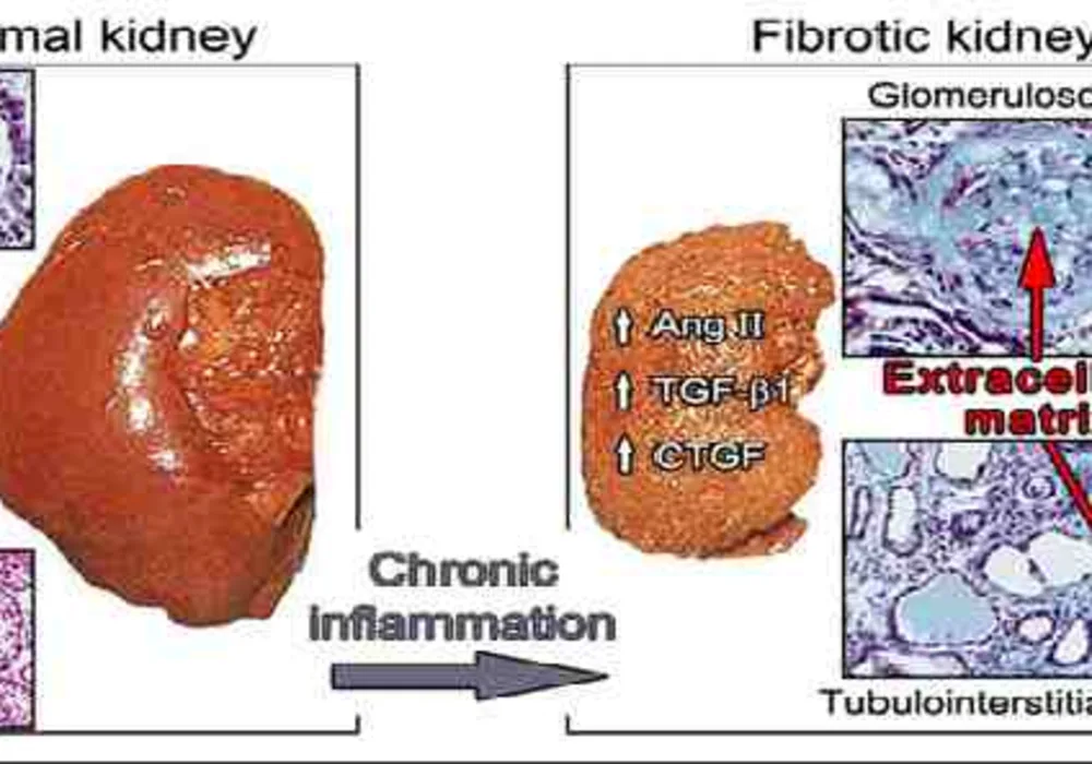 New Therapeutic Strategy for CKD