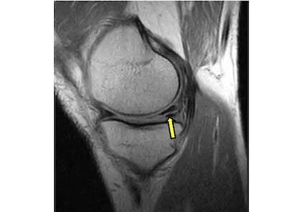 Knee Surgery May Lead to Arthritis, Cartilage Loss