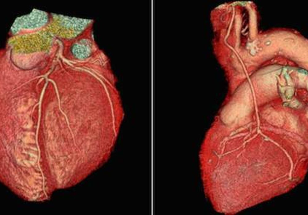 Routine CCTA Screening Not Necessary For Diabetics