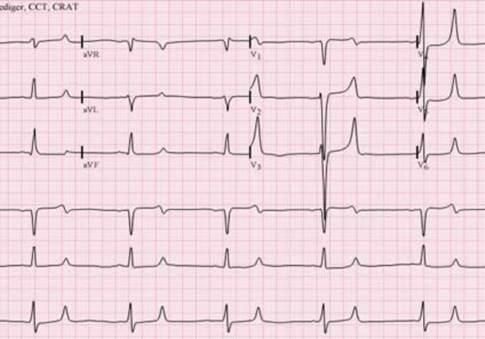 Zirconium Cyclosilicate Effective For Hyperkalaemia 