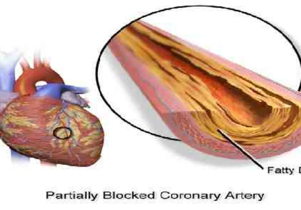 Nonobstructive CAD Linked to Higher Risk of Heart Attack, Death