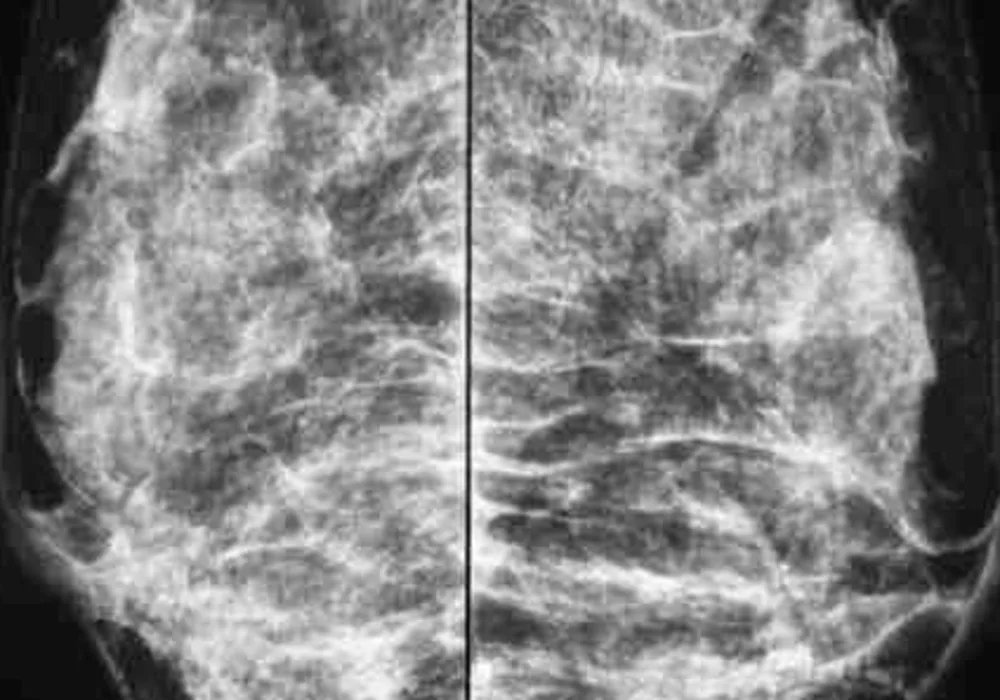 Combining Tomosynthesis and Mammography is Cost-Effective