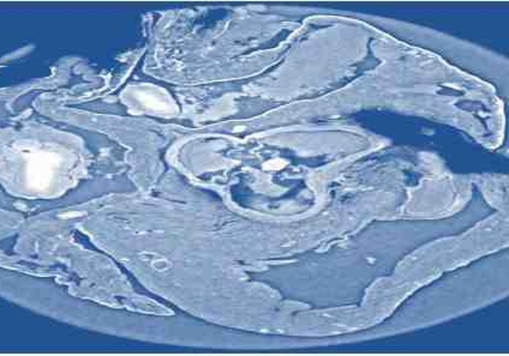 X-Ray Phase Tomography Enhanced with Synchrotron Radiation