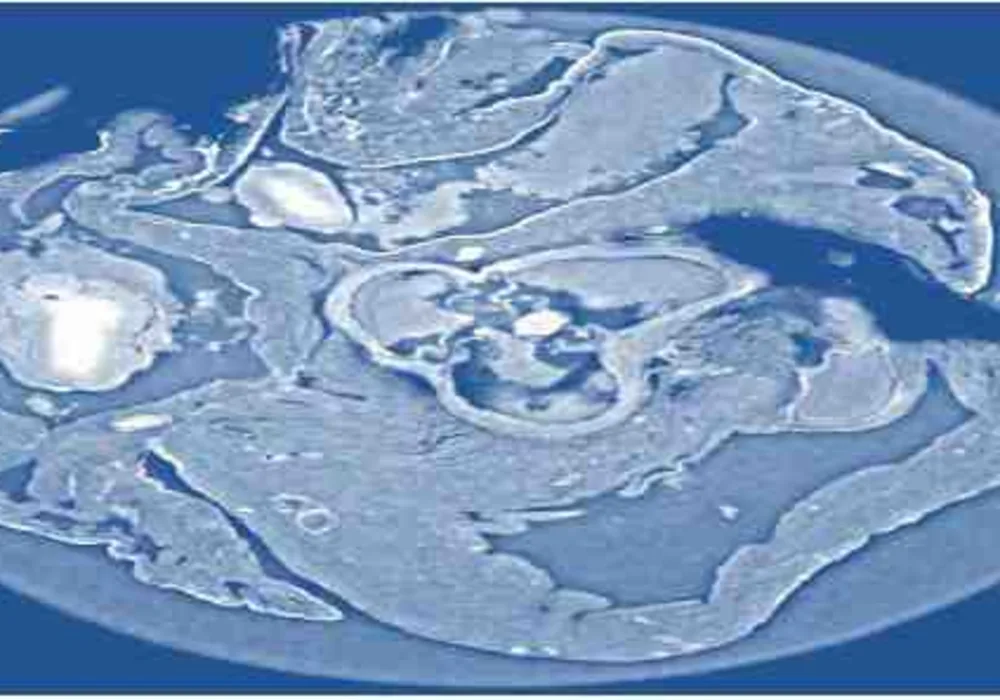 X-Ray Phase Tomography Enhanced with Synchrotron Radiation