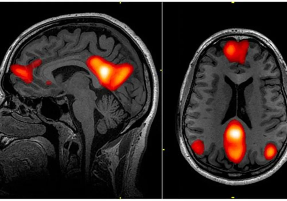 Neuroimaging For Personalised Pain Therapy