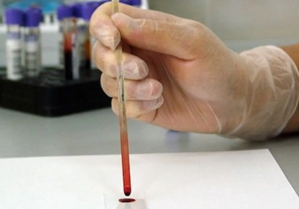 Single-Drop Blood Test For Colorectal Cancers