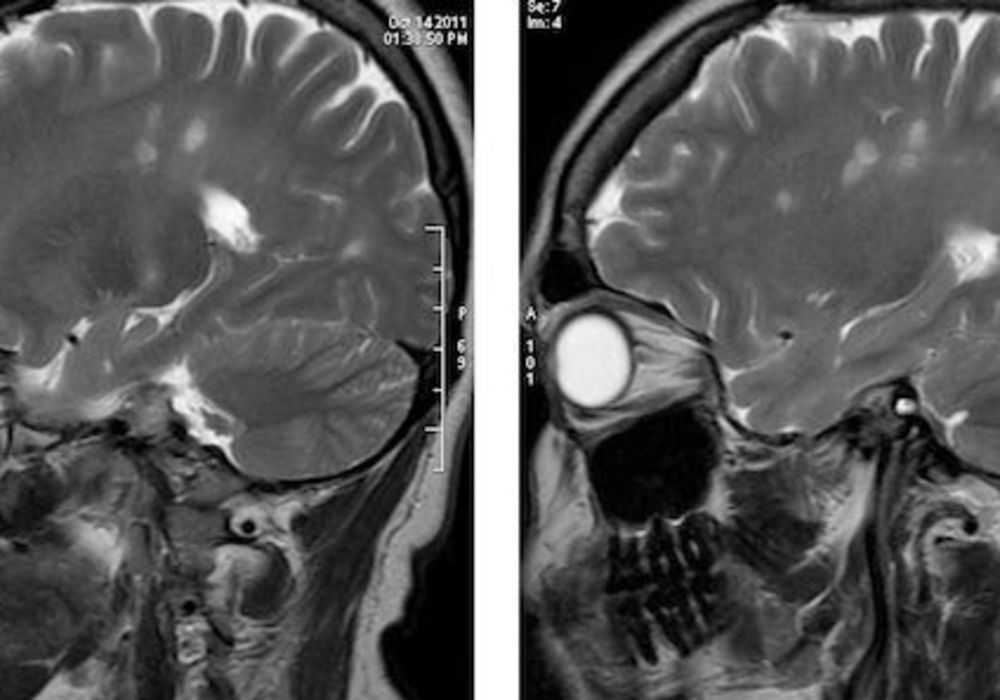 MRI Shows Grey Matter Demyelination in MS