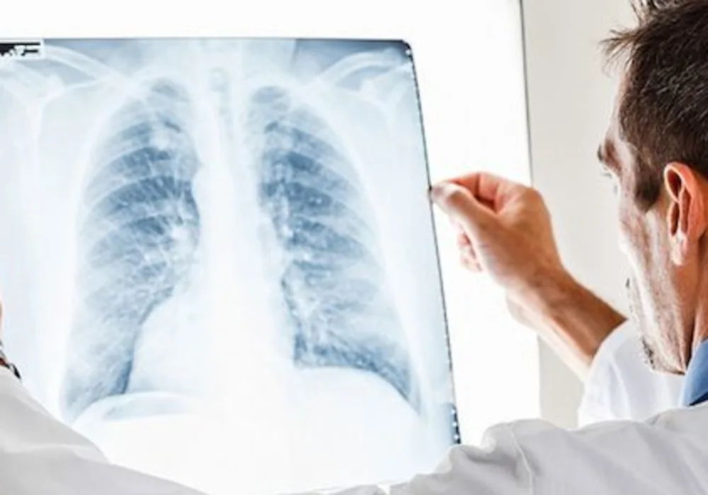 Low-Dose CT Beats X-Ray in Lung Cancer Detection