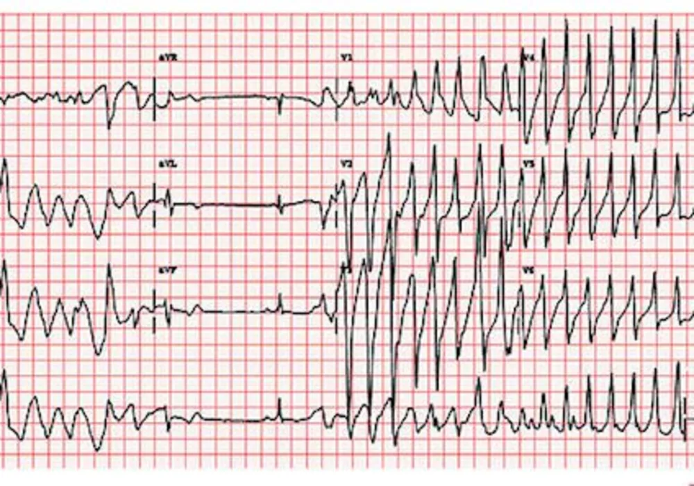 ESC 2014: Expert Consensus on Ventricular Arrhythmias