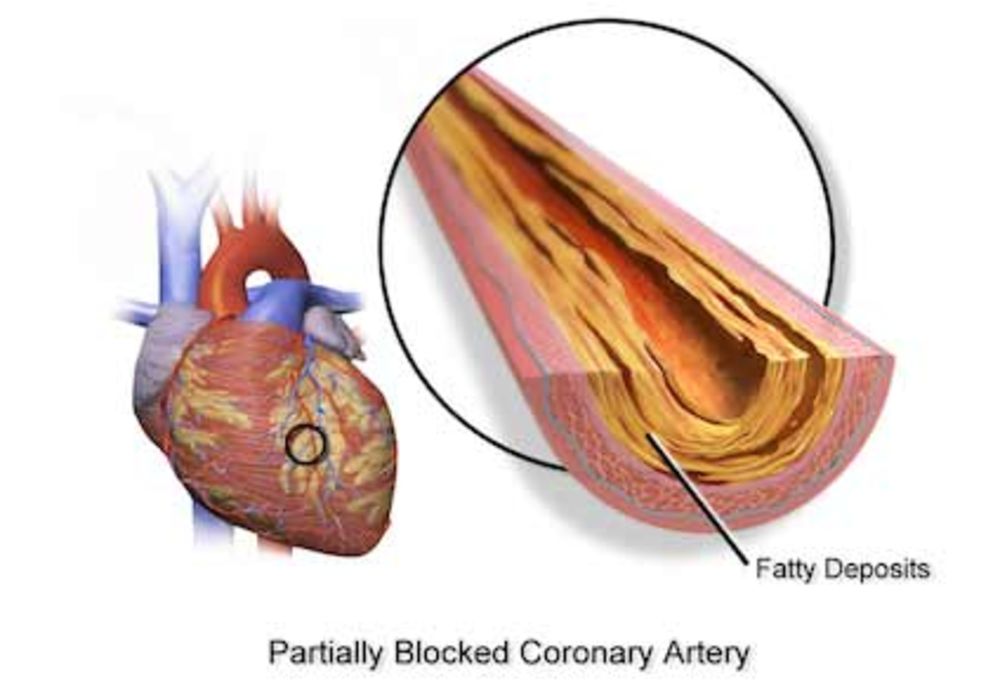 Severe Calcification Ups Risk of Cardiovascular Event