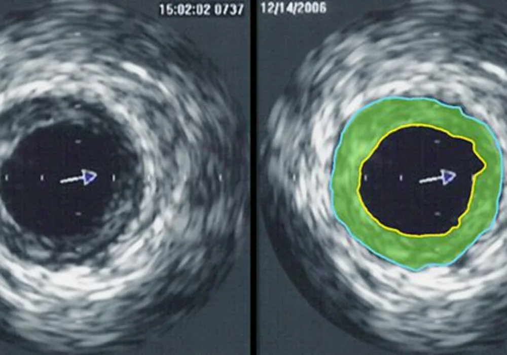 FFR and IVUS-Guided PCI vs Standard PCI 