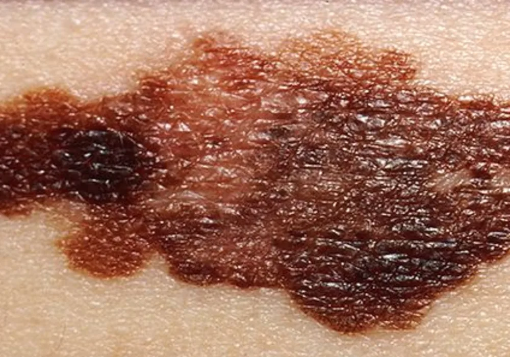 Handheld Device Can Detect Melanoma