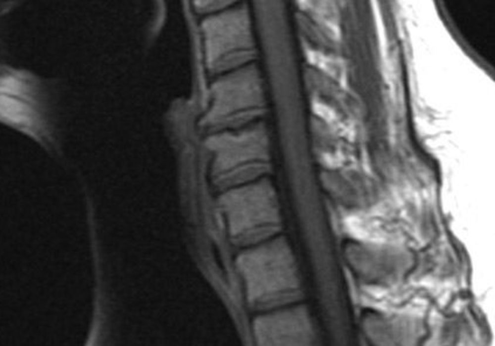 MRI in Cervical Spine Clearance