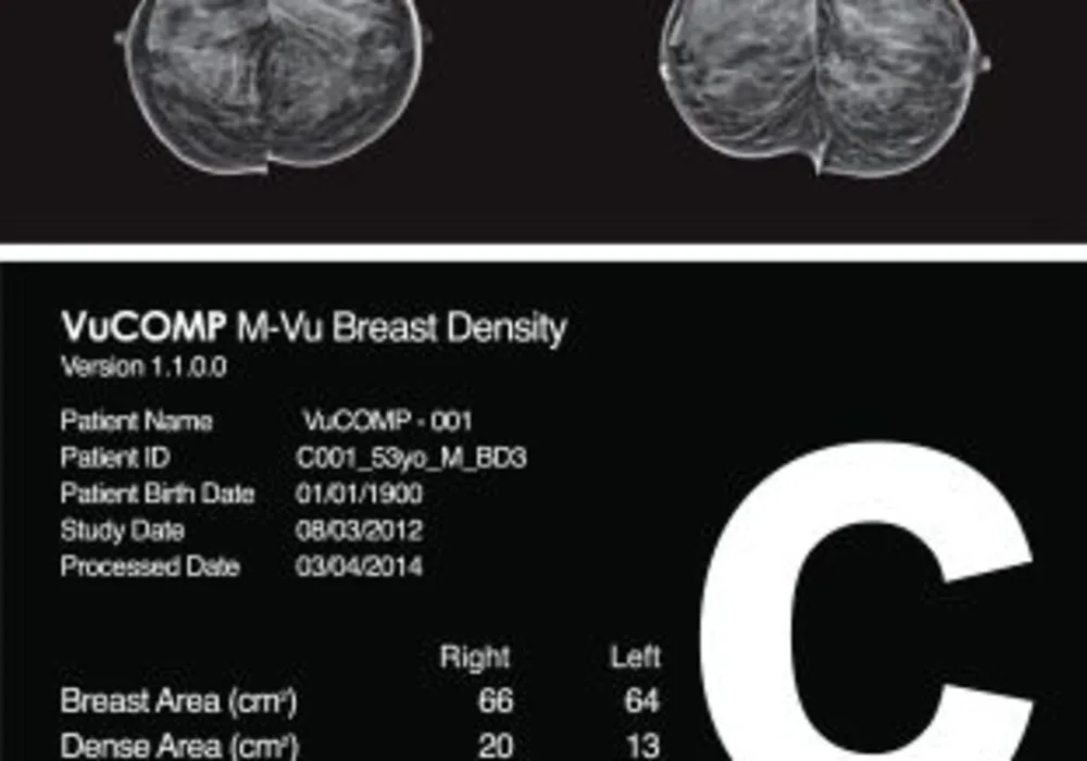 VuCOMP&#039;s M-Vu Breast Density Cleared for Canada 