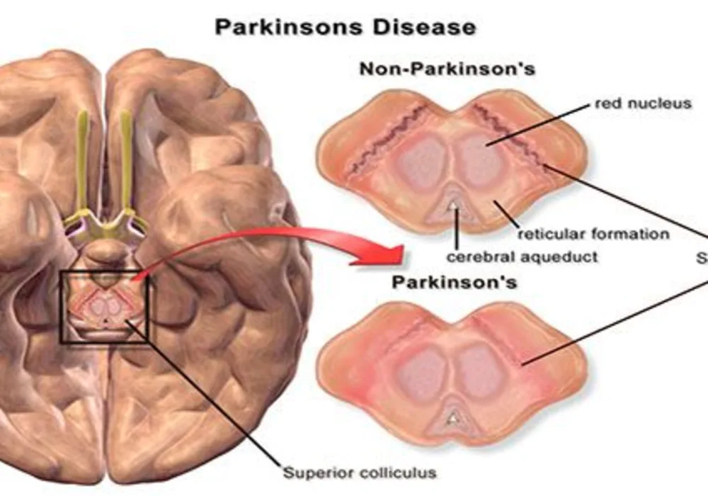 Mapping Technique for Modulation Following Sham Surgery