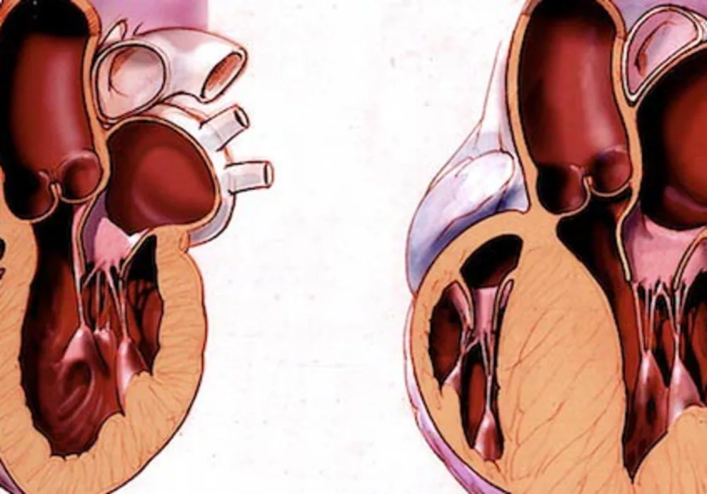 Cardiac Hypertrophy: Preventable via Protein