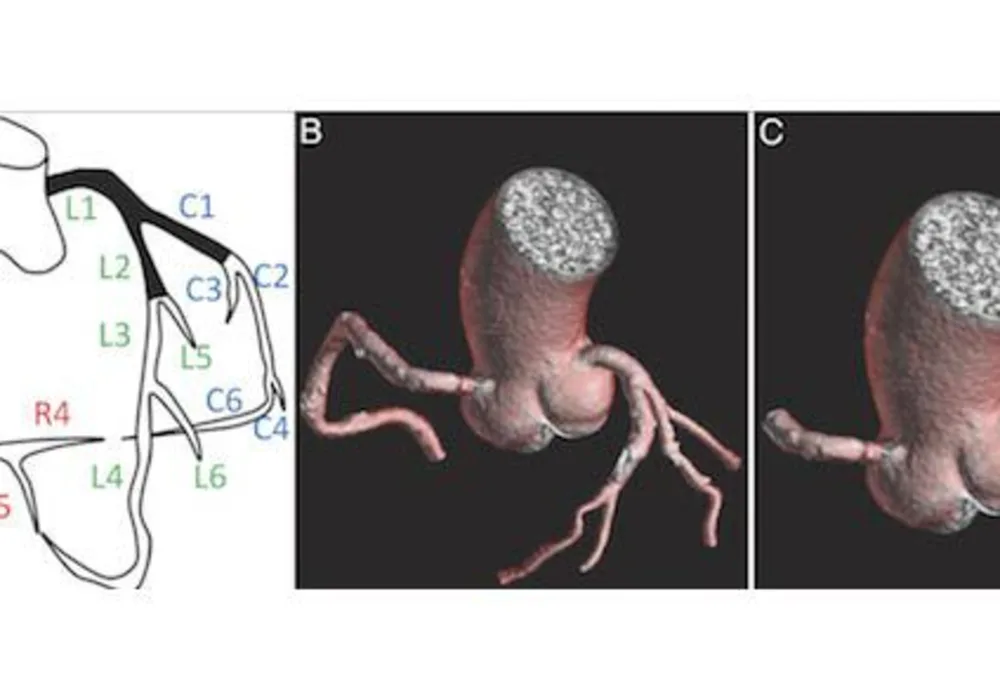 Study: CT Offers Measurement Tool for Arterial Plaque in Diabetic Patients