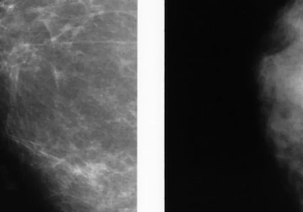 ECR 2014: Volpara Solutions Launches Two Quantitative Breast Imaging Tools 