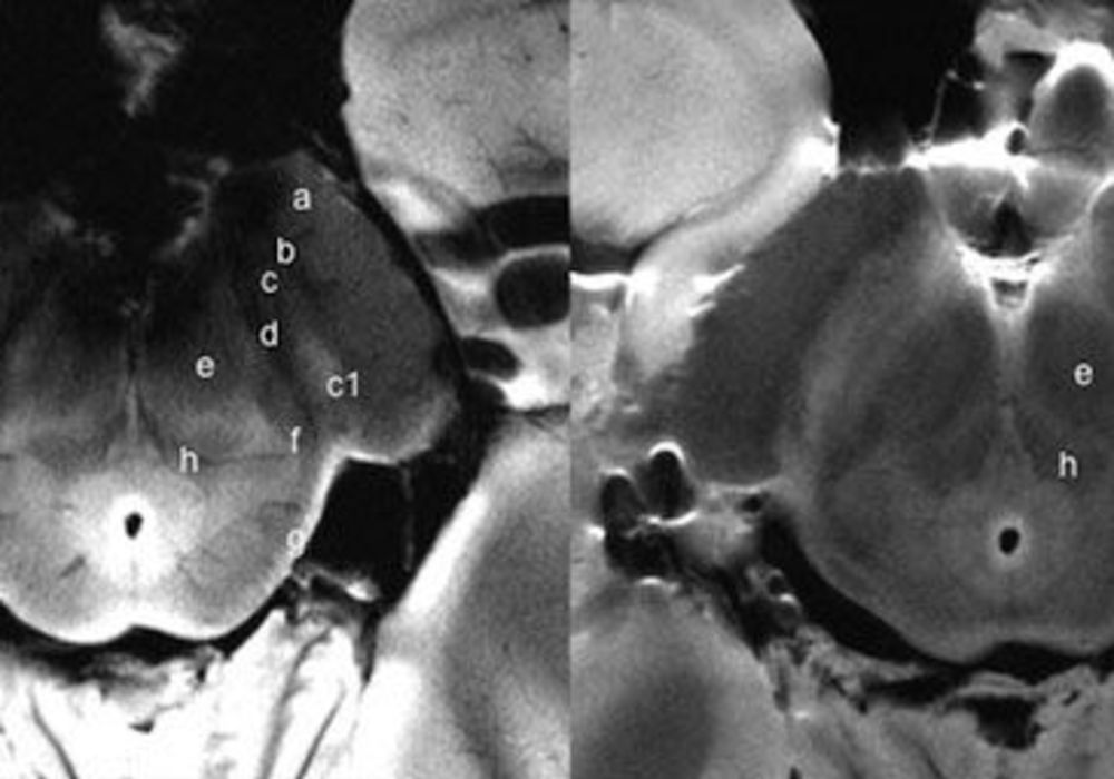 Study: 7-T MRI Offers Supporting Radiologic Diagnosis of Parkinson&rsquo;s Disease