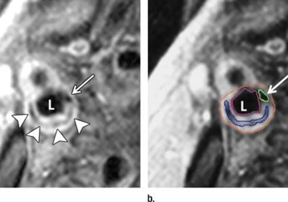 Carotid Artery MRI Predicts Strokes and Heart Attacks 