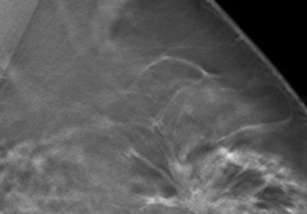 Photon-Counting Technique Increases Detection Rate in Screening Mammography  