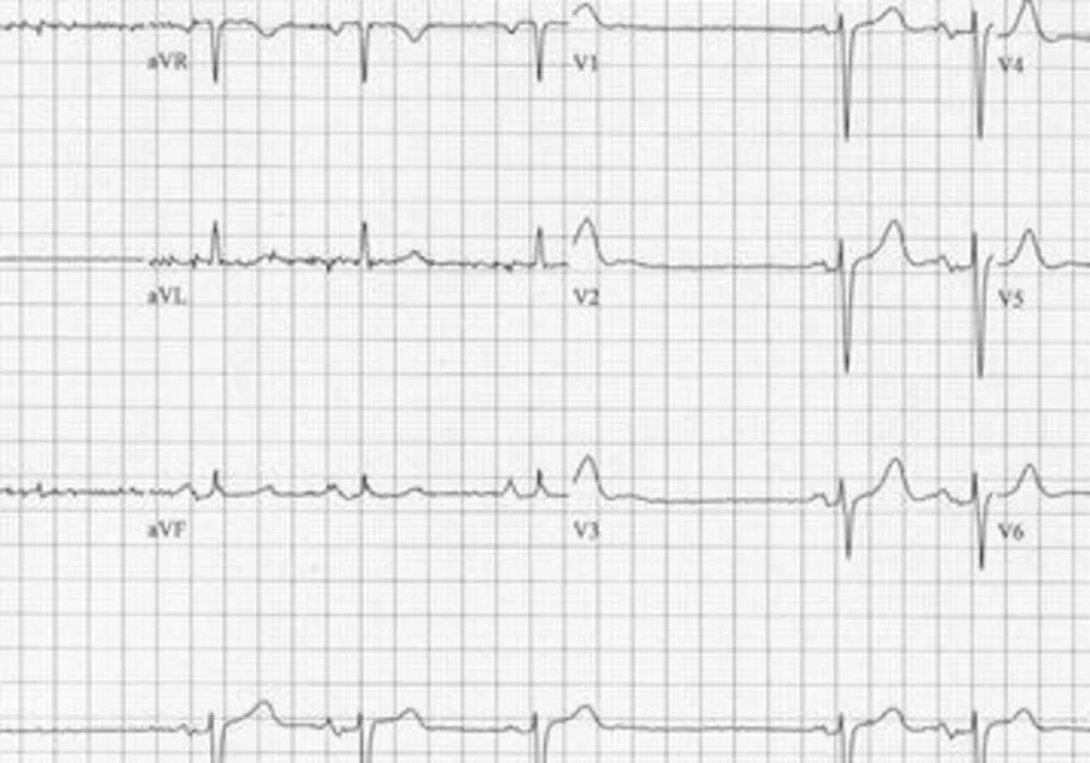 Delayed Enhancement MRI Useful For Determining Arrhythmia Treatment 