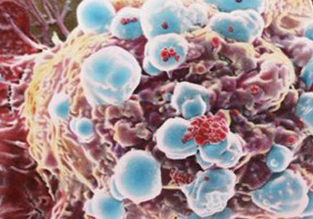 Spread of Cancer Potentially Halted by &lsquo;Sticky Balls&rsquo;