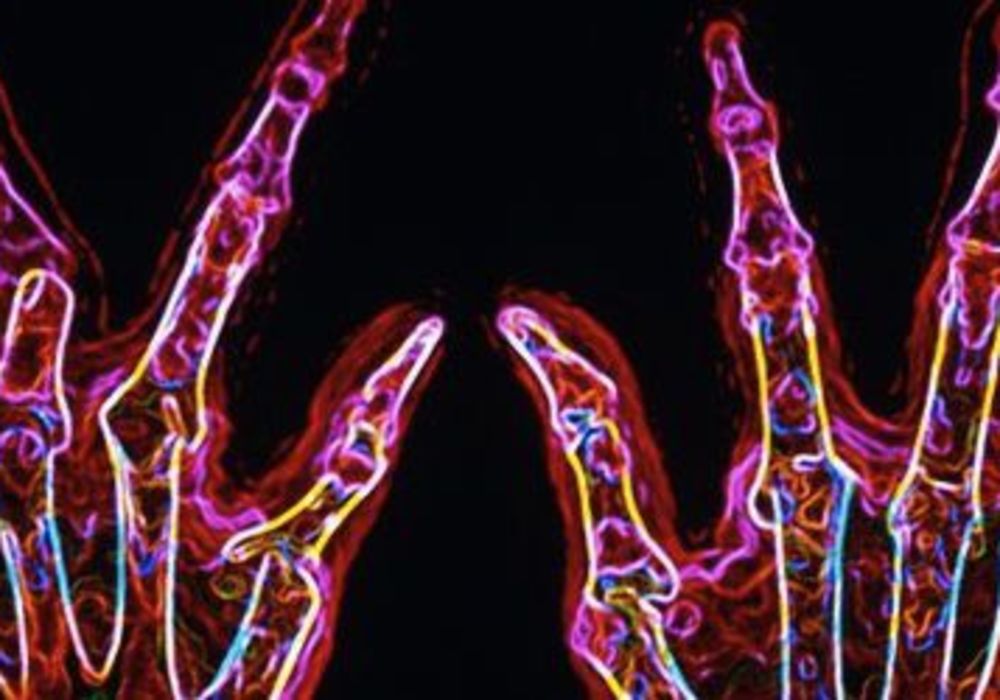 Large Scale DNA Study Offers Clues for Rheumatoid Arthritis 