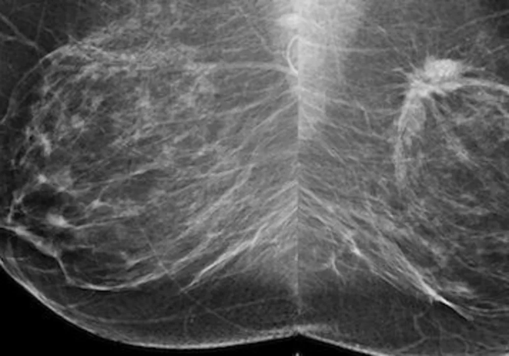 RSNA 2013: Breast Cancer Prognosis Potentially Affected by Screening Intervals 