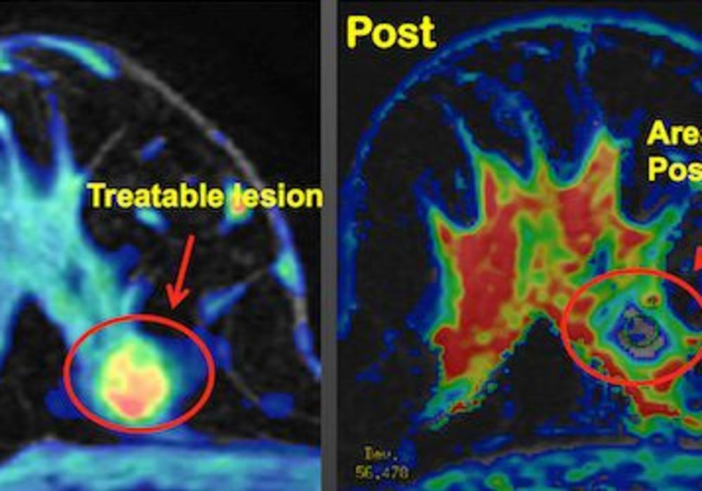 RSNA 2013: MR-guided Ultrasound Offers Noninvasive Treatment for Breast Cancer