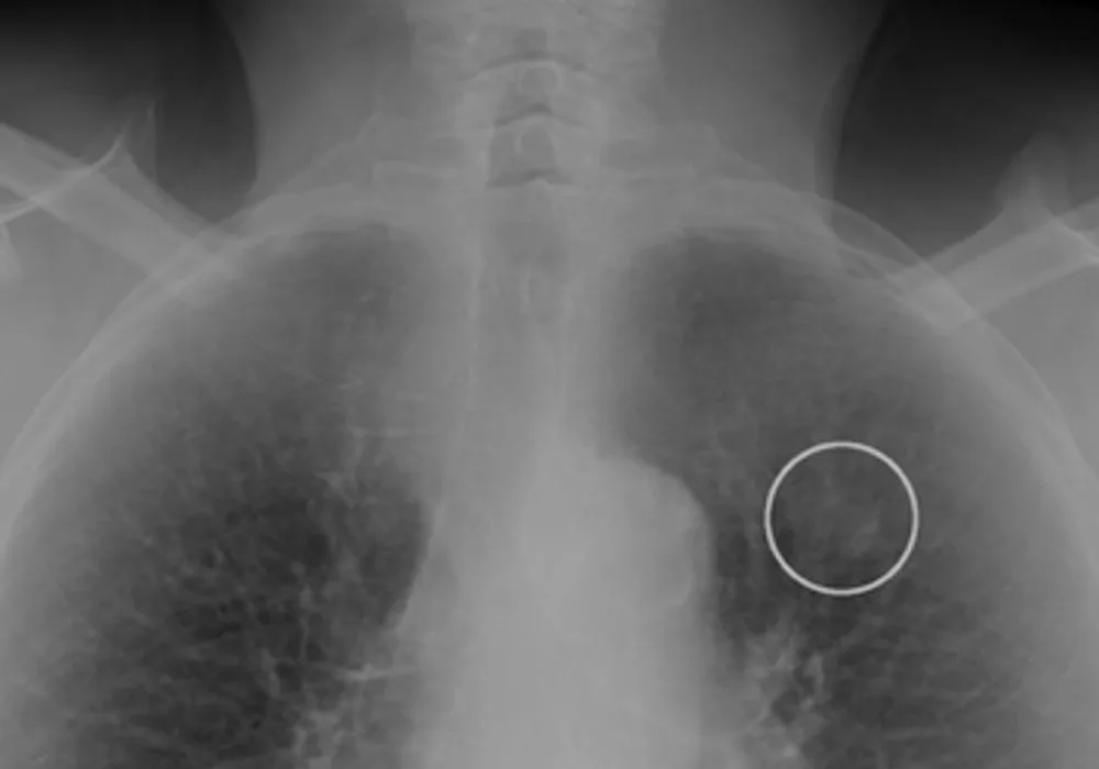 RSNA 2013: Riverain Chest X-ray CAD Detects Previously Missed Lung Cancers 