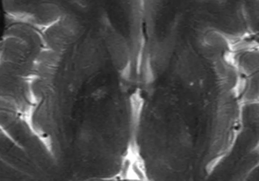 RSNA 2013: Brain Differences in Preterm Infants Highlighted via MR Spectroscopy 