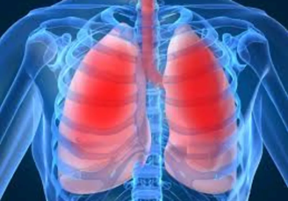 Newly Identified Biomarkers Help Predict Outcome in Deadly Lung Disease