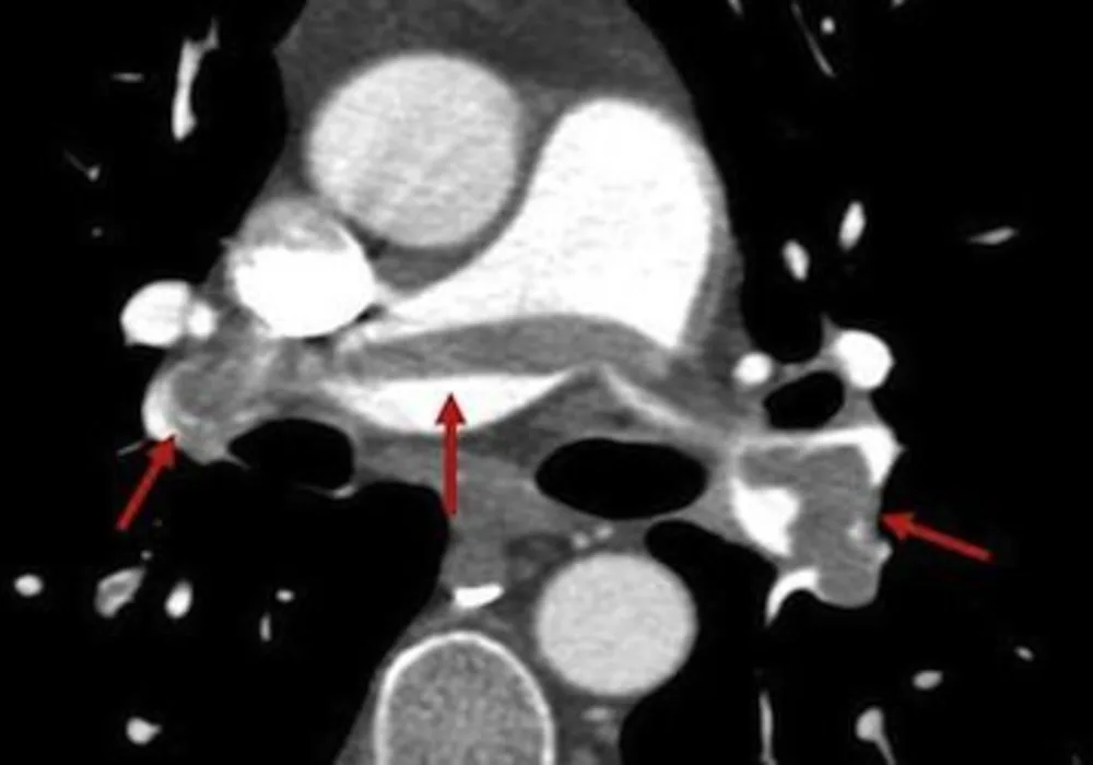 Has CT Scanning Caused Overdiagnosis of Pulmonary Emboli? 