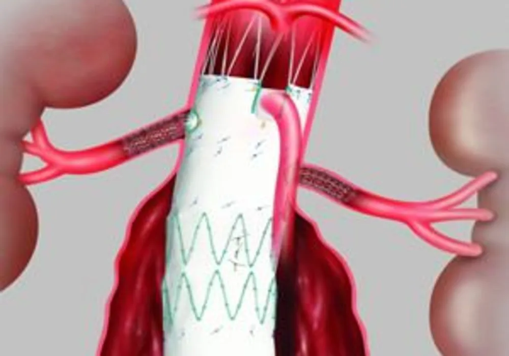 New Minimally Invasive Procedure for Abdominal Aortic Aneurysms