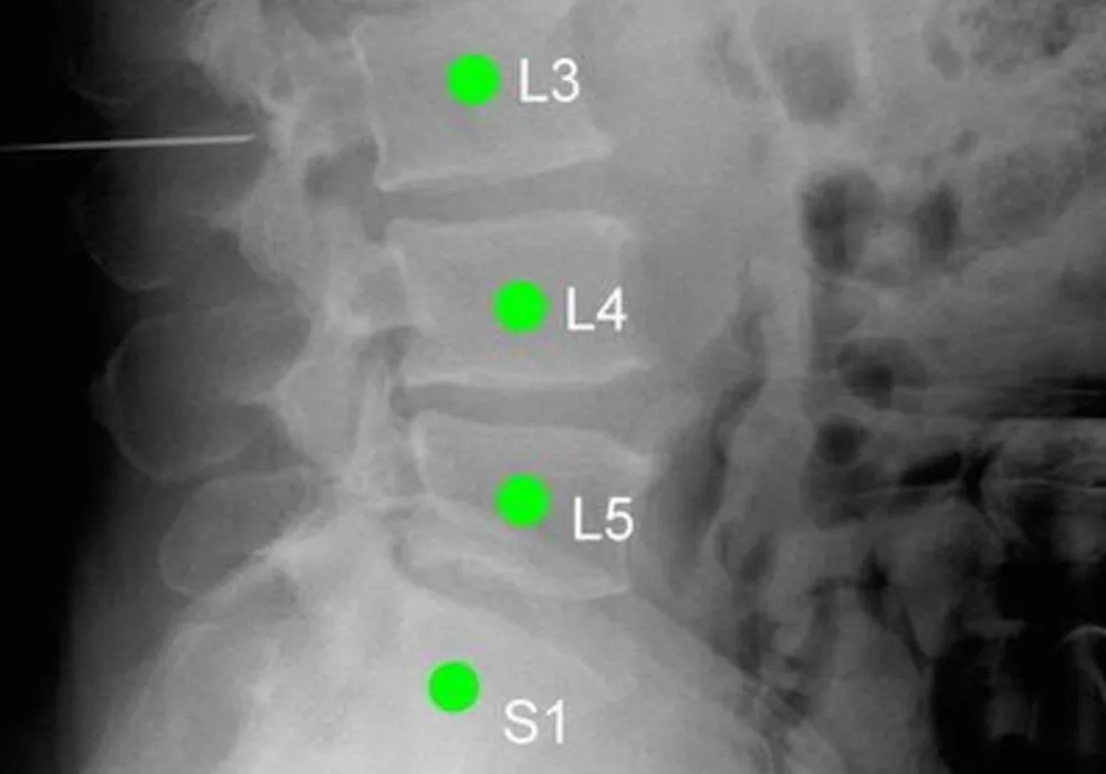 Software Improves Accuracy of Spinal Surgery