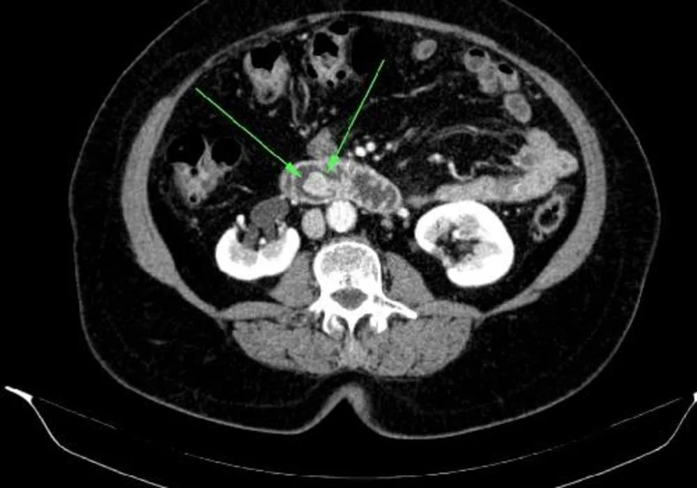 Pancreatic Cancer: MRI Protocol for High-Risk Patients