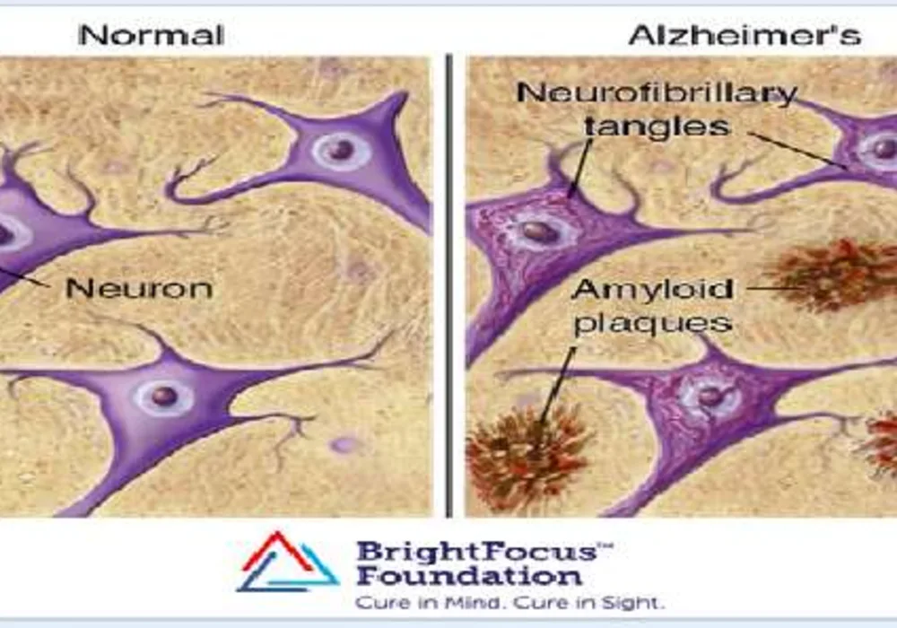 Noninvasive Ultrasound Technology Could Treat Alzheimer&rsquo;s Disease