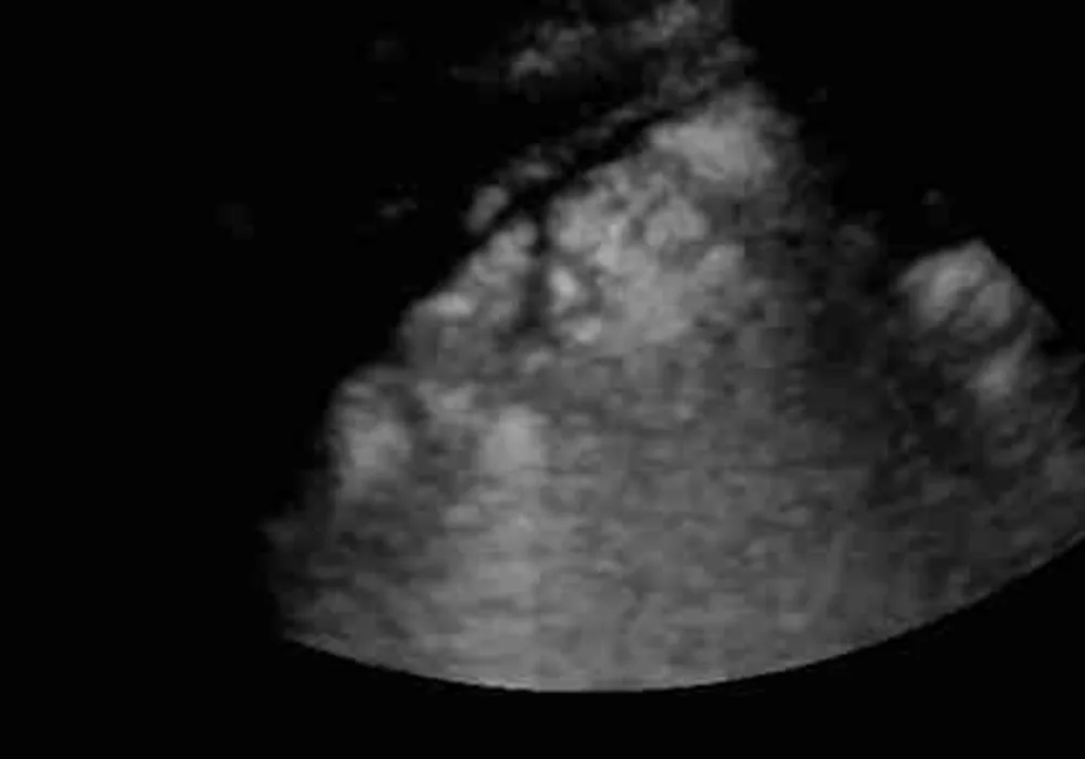 Point-of-Care Ultrasound: Potential and Limitations