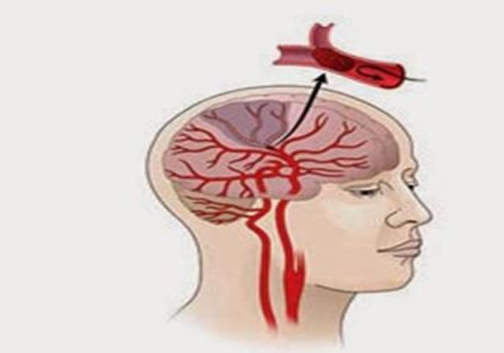 Stroke Patients Receiving Timely Care