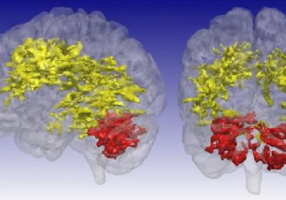 Bipolar Disorder: New MRI Method Provides New Insights