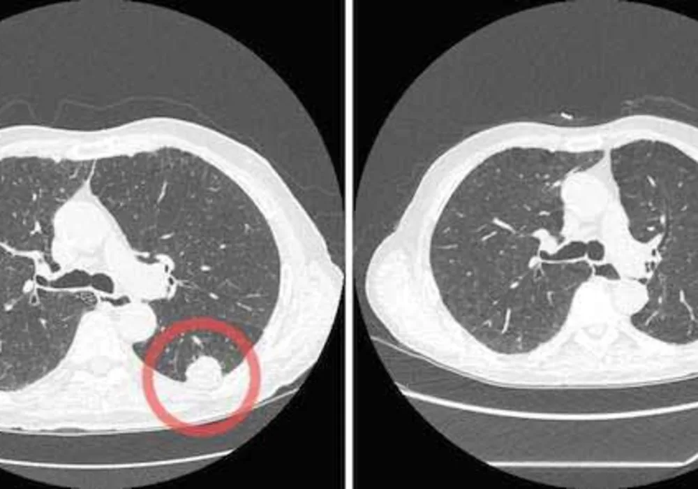 Medicare To Cover Low-Dose CT Screening for Lung Cancer