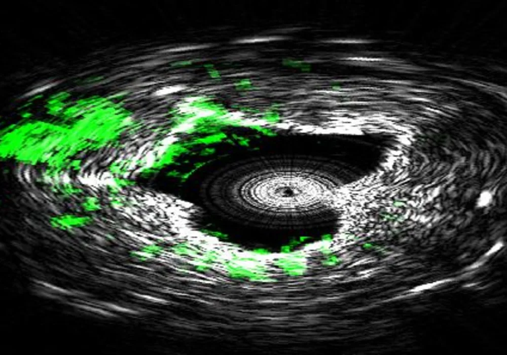 High-Speed Imaging for Cardiovascular Disease Diagnosis