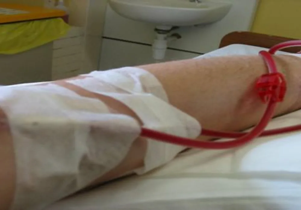 More Men Than Women Receive Haemodialysis Treatment 