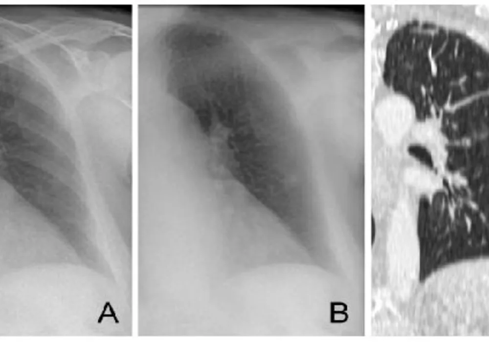 Bone Suppression Optimises Chest X-ray&#039;s IPA Diagnosis
